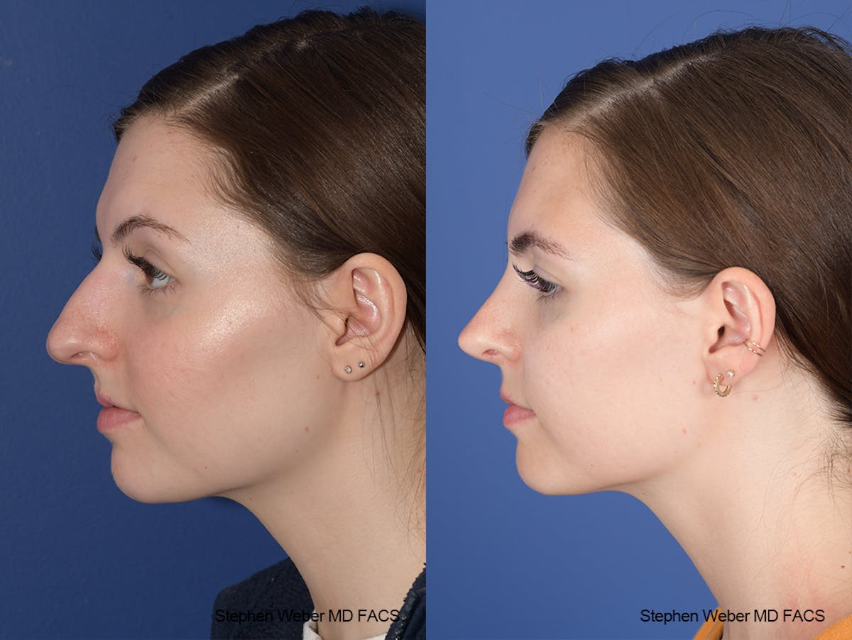 Rhinoplasty Before & After Gallery - Patient 306580 - Image 2