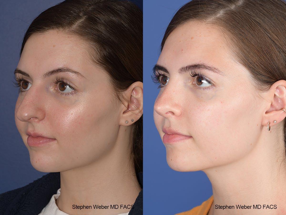 Rhinoplasty Before & After Gallery - Patient 306580 - Image 3