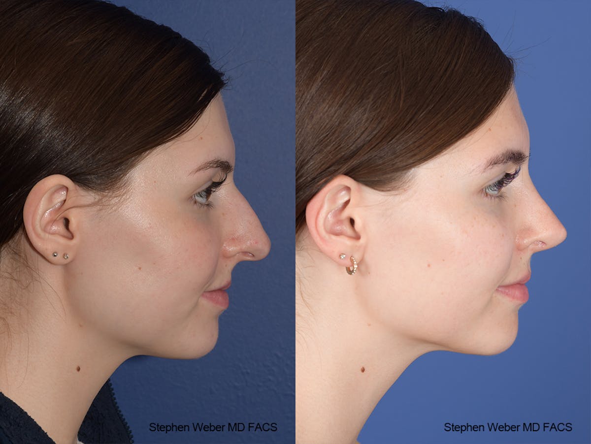 Rhinoplasty Before & After Gallery - Patient 306580 - Image 4