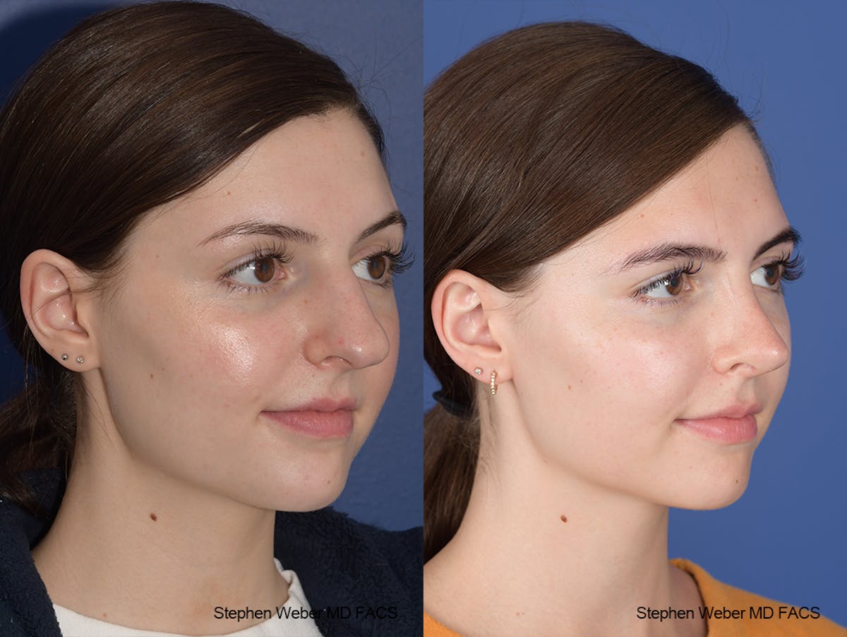 Rhinoplasty Before & After Gallery - Patient 306580 - Image 5