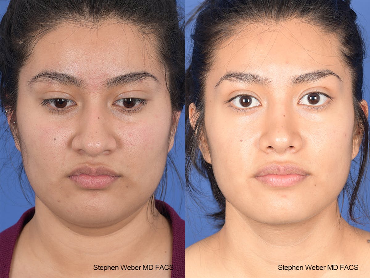 Rhinoplasty Before & After Gallery - Patient 102355 - Image 1