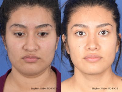 Rhinoplasty Before & After Gallery - Patient 102355 - Image 1