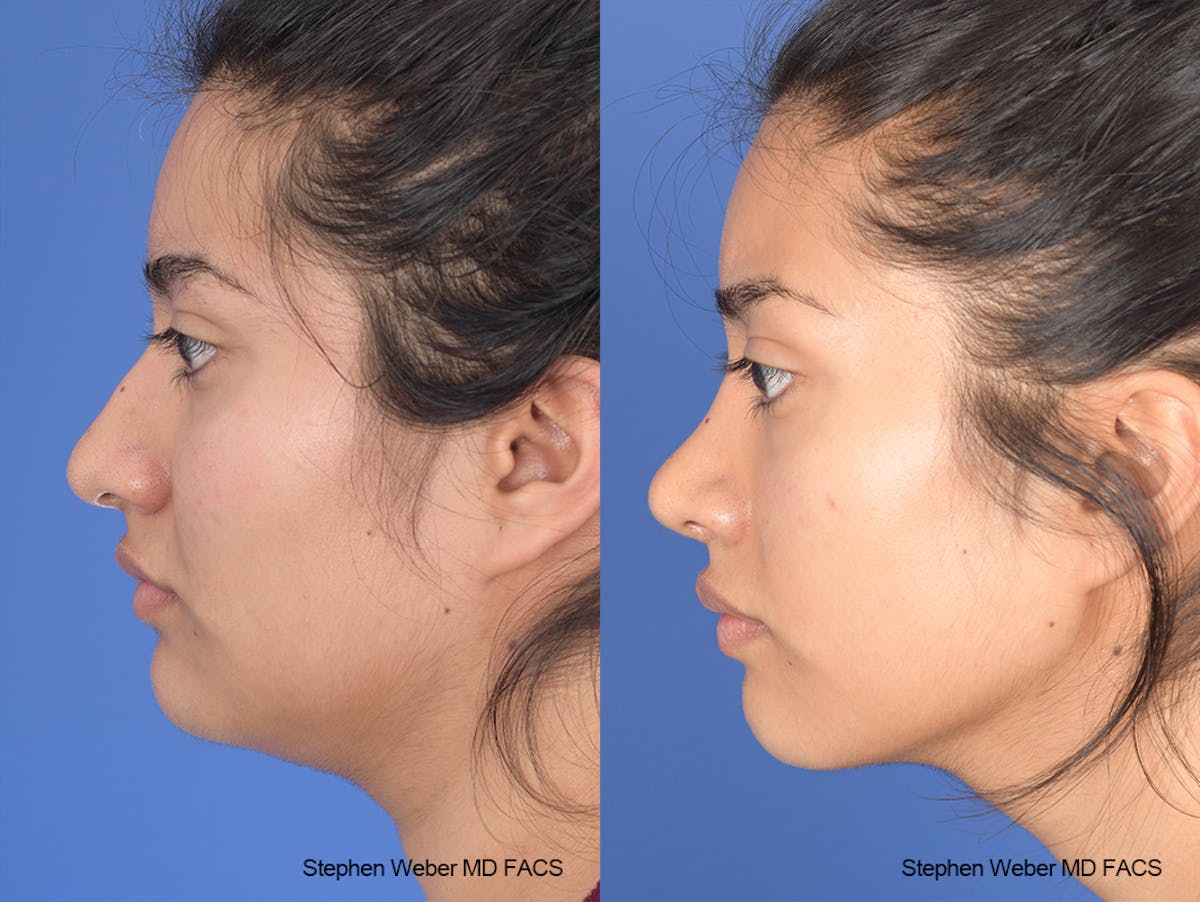 Rhinoplasty Before & After Gallery - Patient 102355 - Image 2