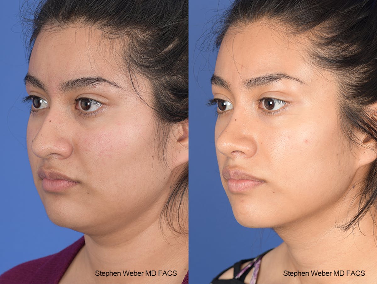 Rhinoplasty Before & After Gallery - Patient 102355 - Image 3