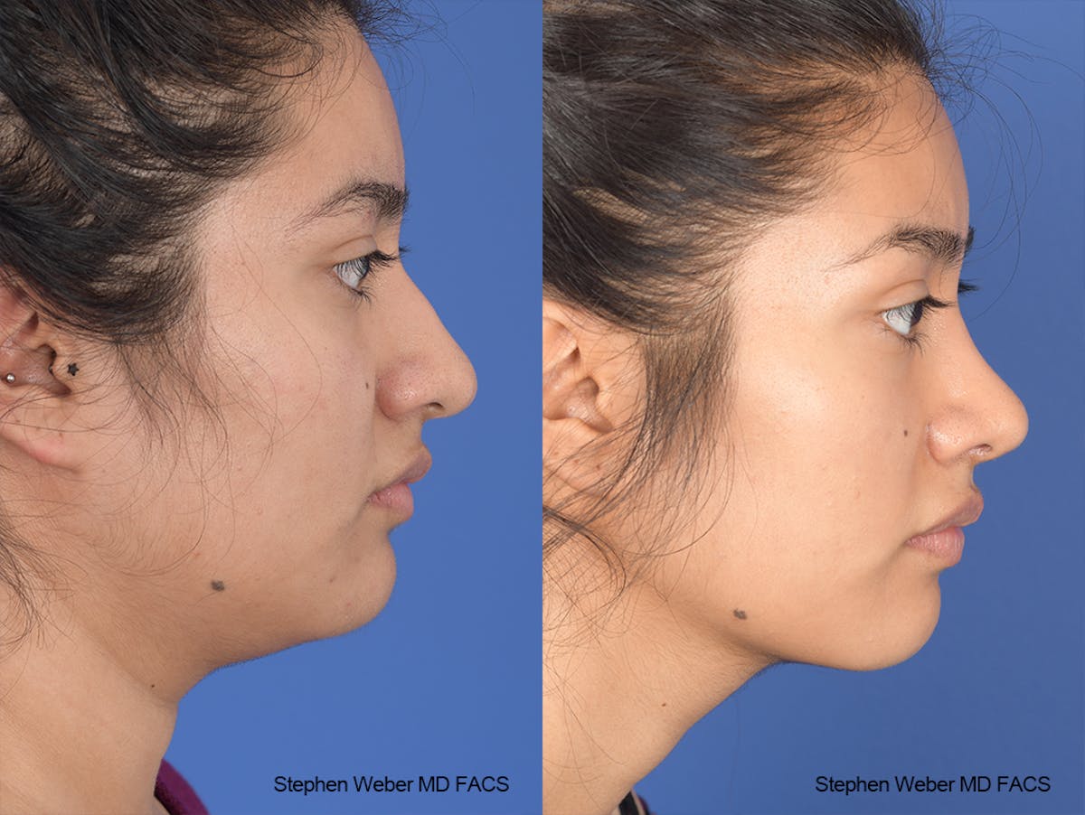 Rhinoplasty Before & After Gallery - Patient 102355 - Image 4