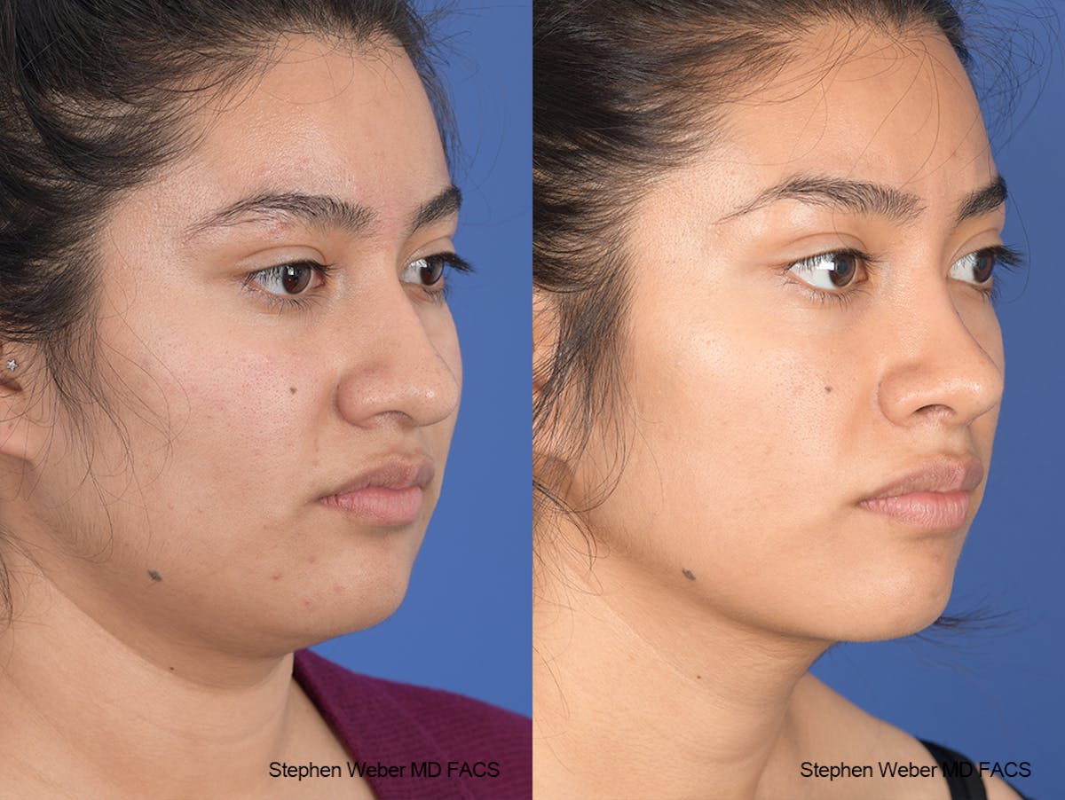 Rhinoplasty Before & After Gallery - Patient 102355 - Image 5