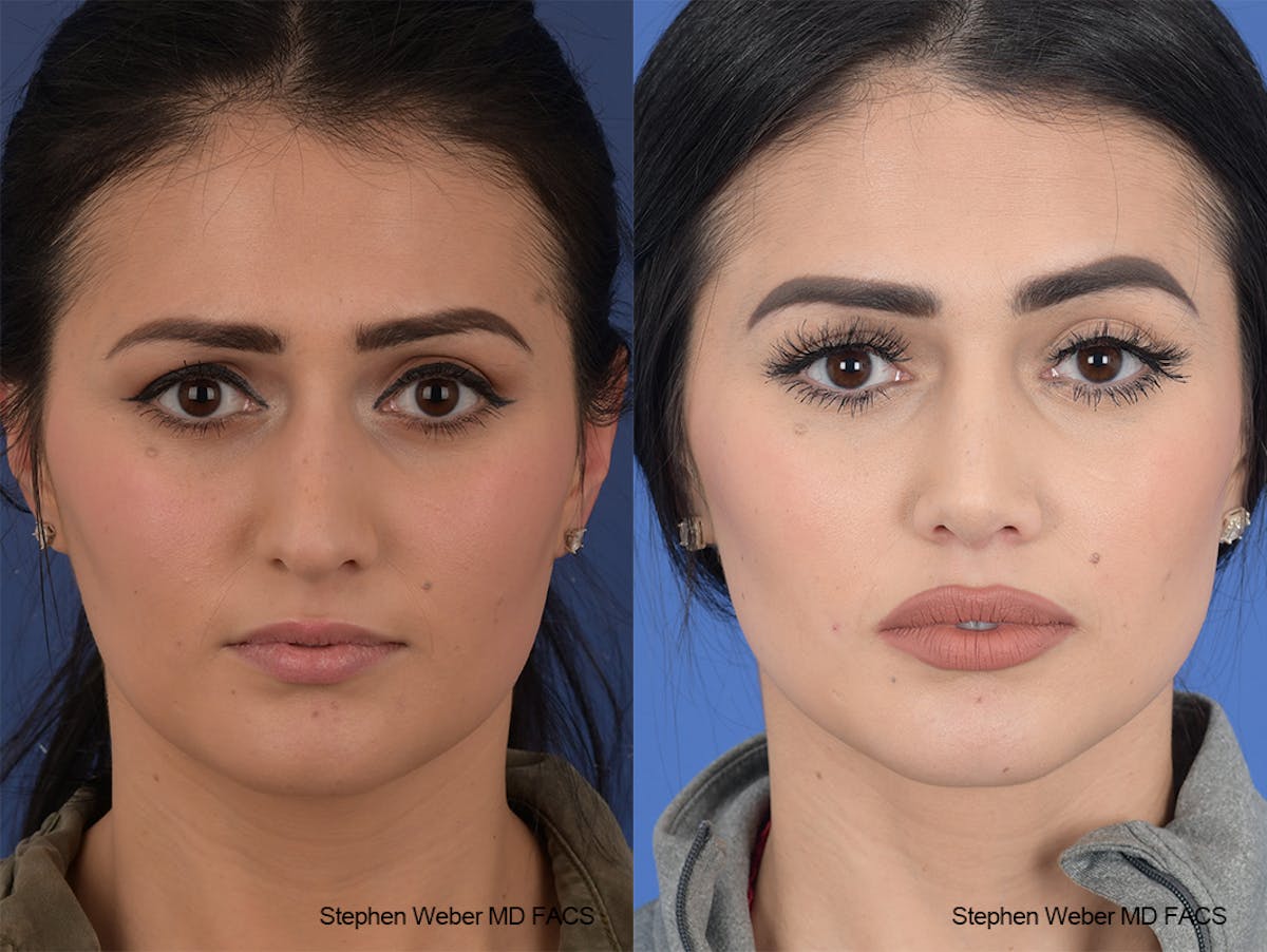 Rhinoplasty Before & After Gallery - Patient 169130 - Image 1