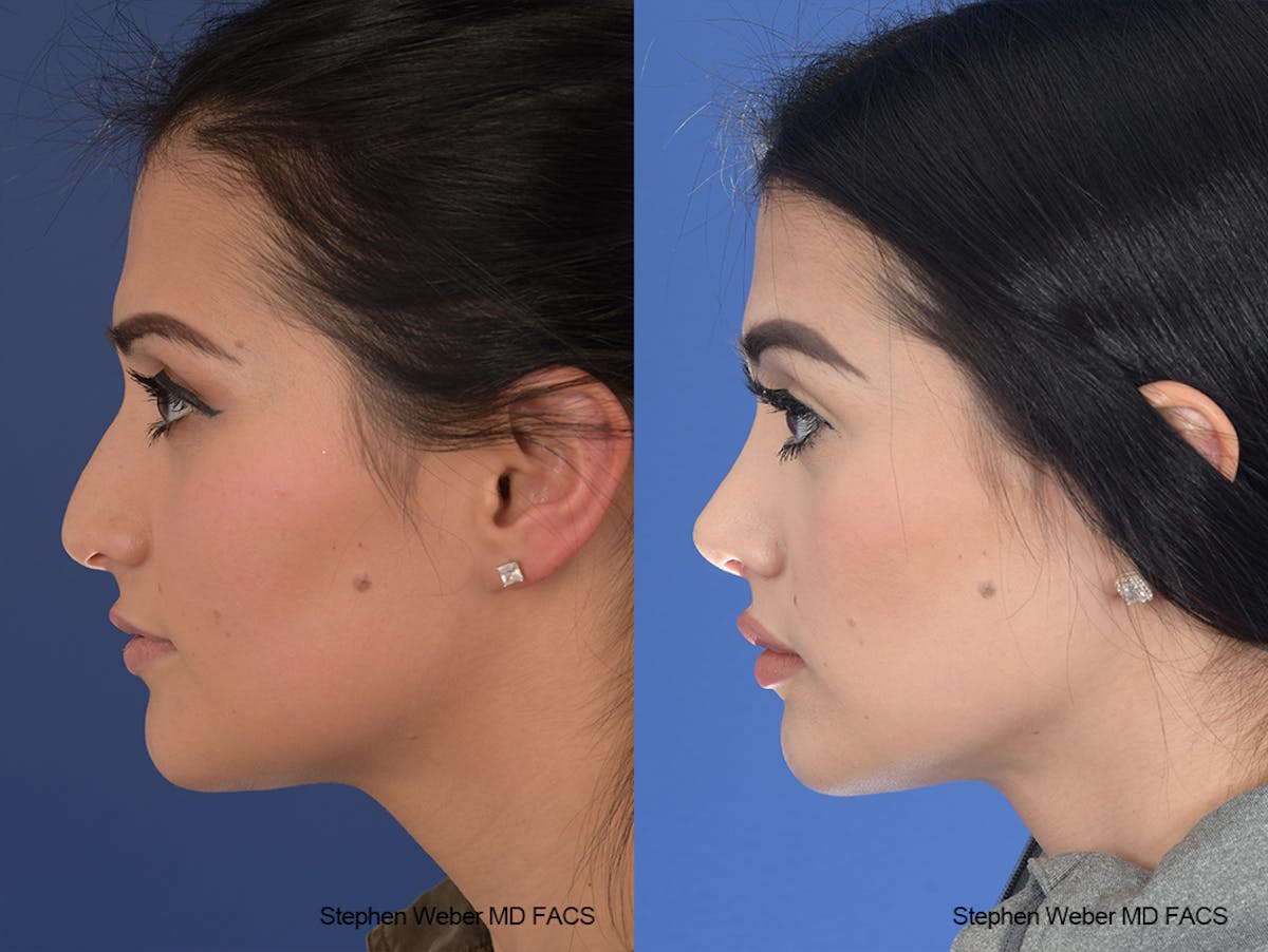 Rhinoplasty Before & After Gallery - Patient 169130 - Image 2