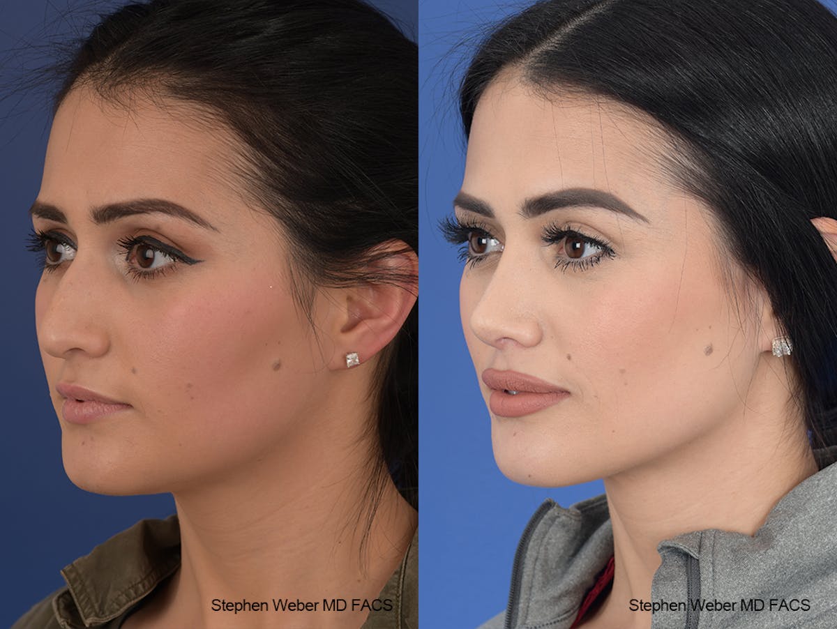 Rhinoplasty Before & After Gallery - Patient 169130 - Image 3