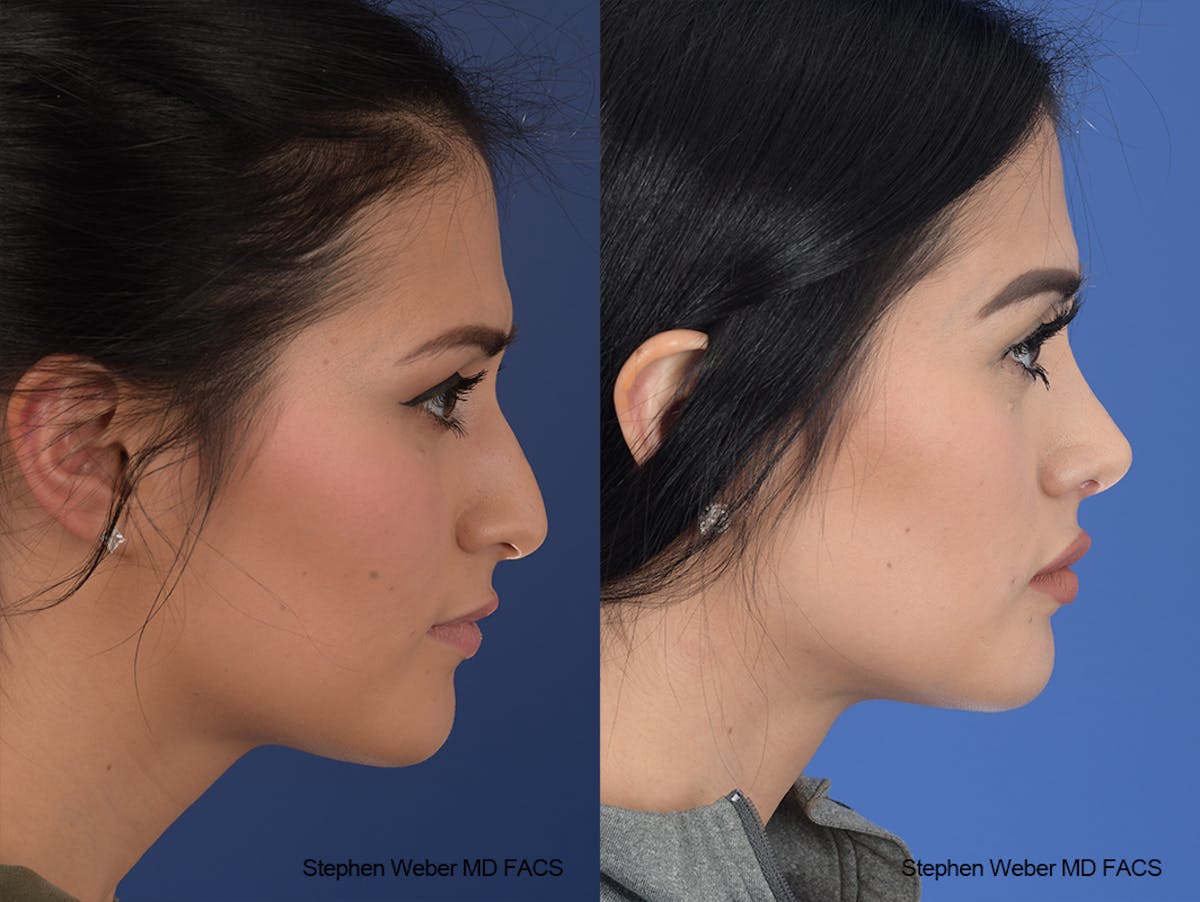 Rhinoplasty Before & After Gallery - Patient 169130 - Image 4