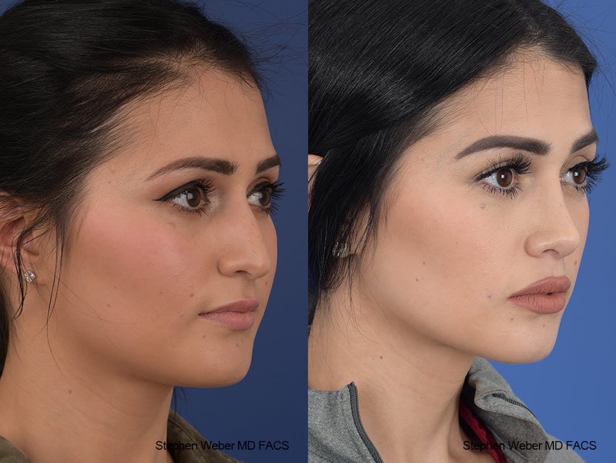 Rhinoplasty Before & After Gallery - Patient 169130 - Image 5