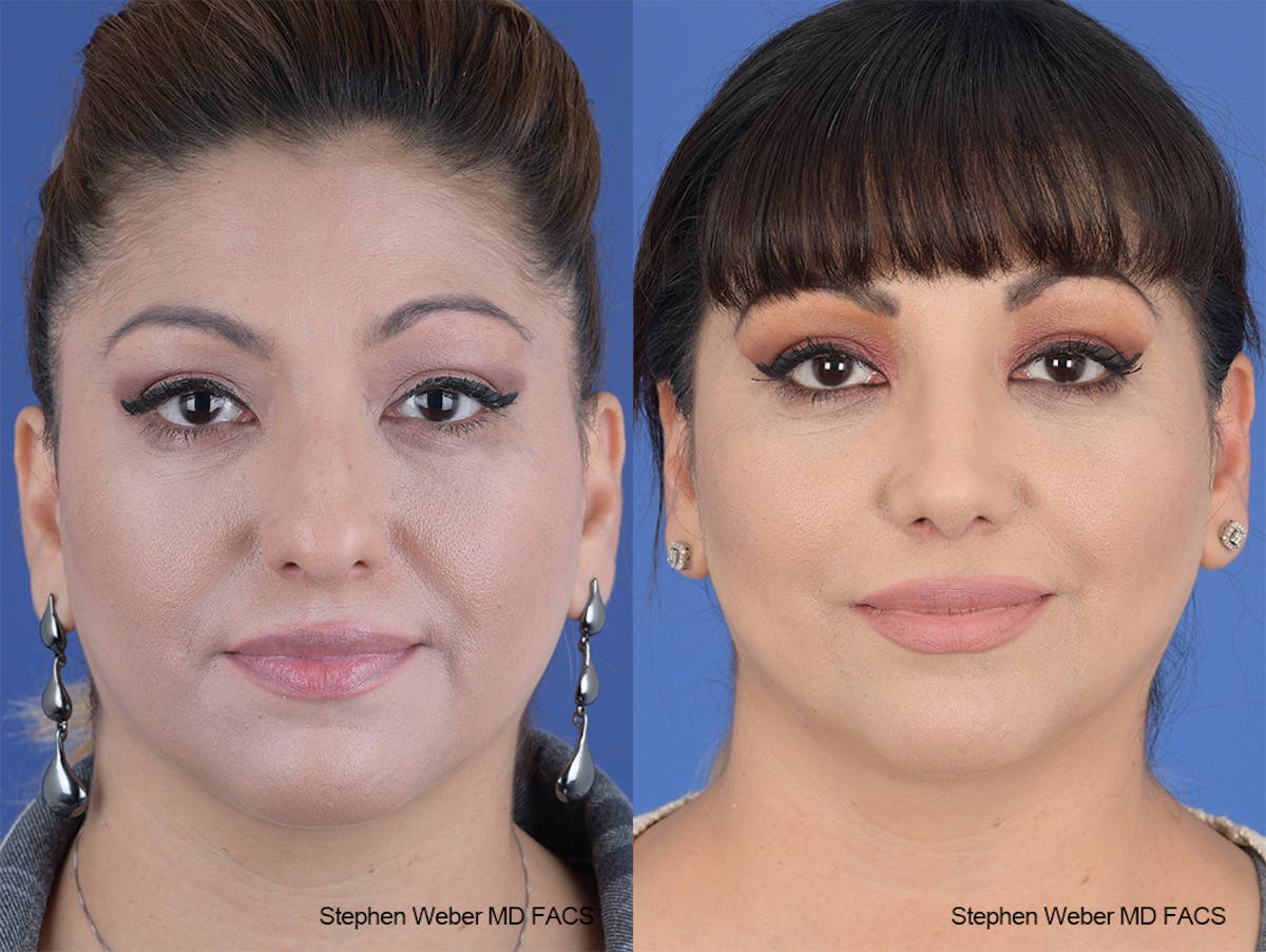 Rhinoplasty Before & After Gallery - Patient 134475 - Image 1