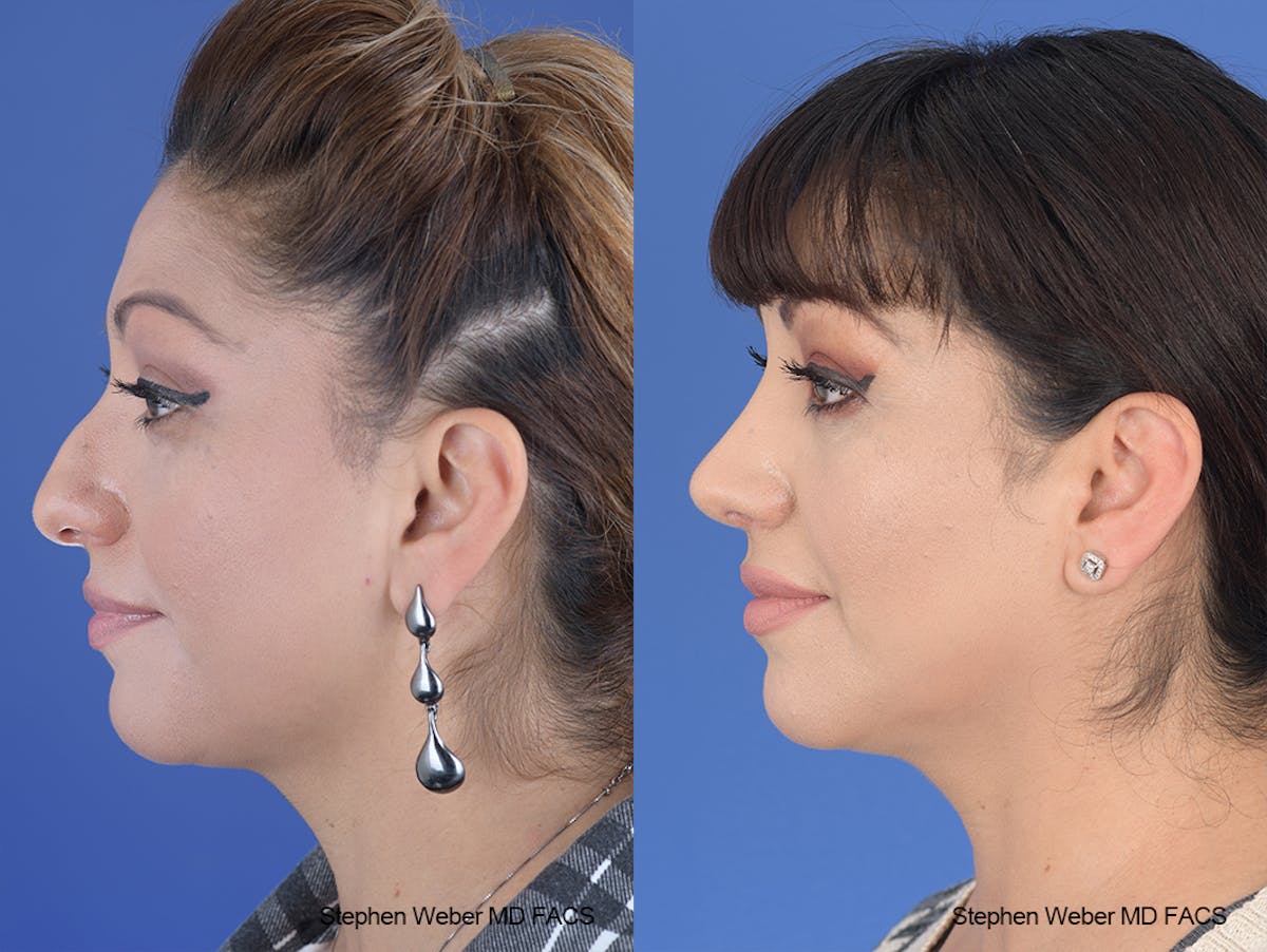 Rhinoplasty Before & After Gallery - Patient 134475 - Image 2