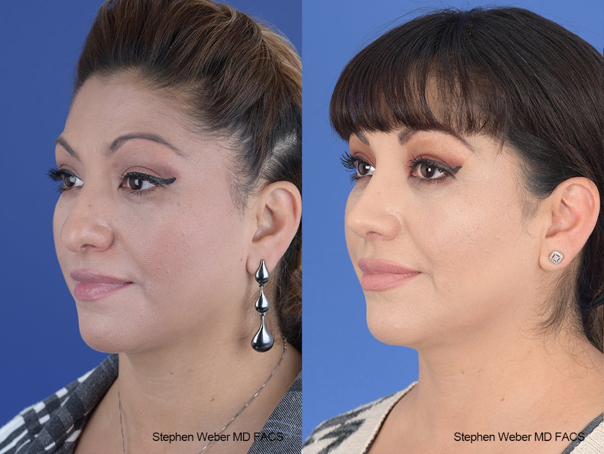 Rhinoplasty Before & After Gallery - Patient 134475 - Image 3