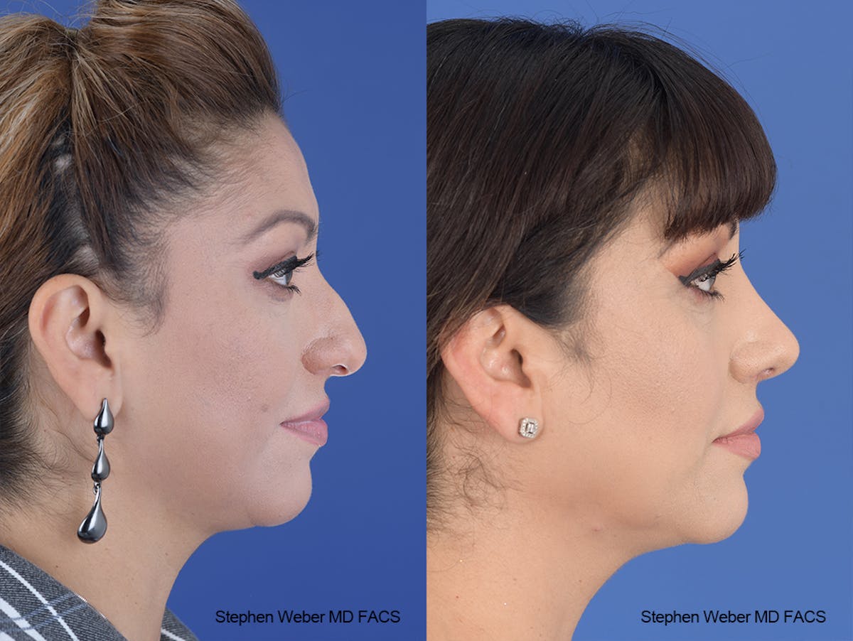 Rhinoplasty Before & After Gallery - Patient 134475 - Image 4