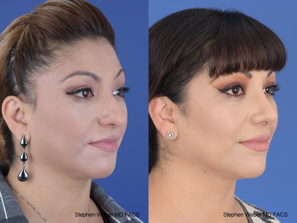 Rhinoplasty Before & After Gallery - Patient 134475 - Image 5