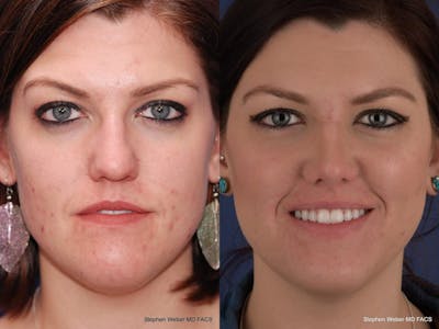 Rhinoplasty Before & After Gallery - Patient 180062 - Image 1