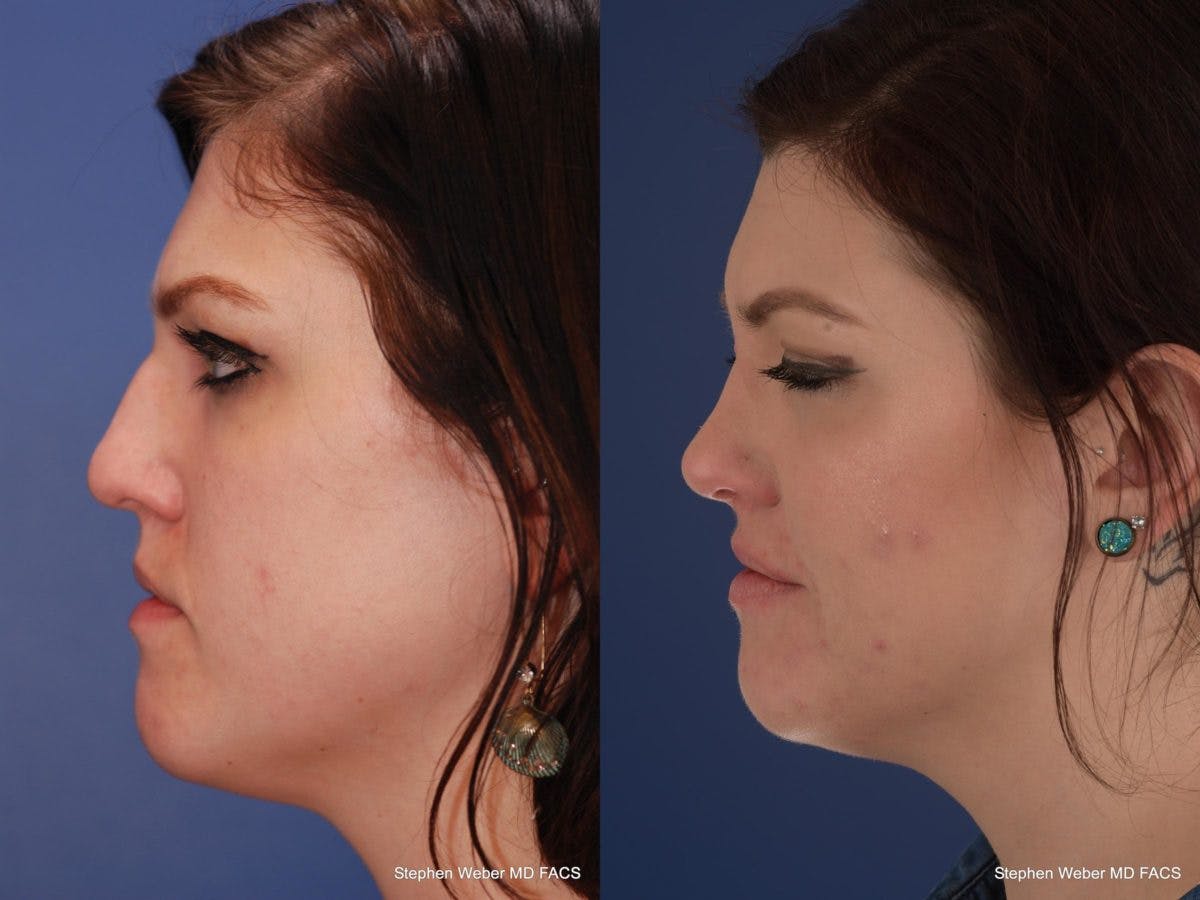 Rhinoplasty Before & After Gallery - Patient 180062 - Image 2
