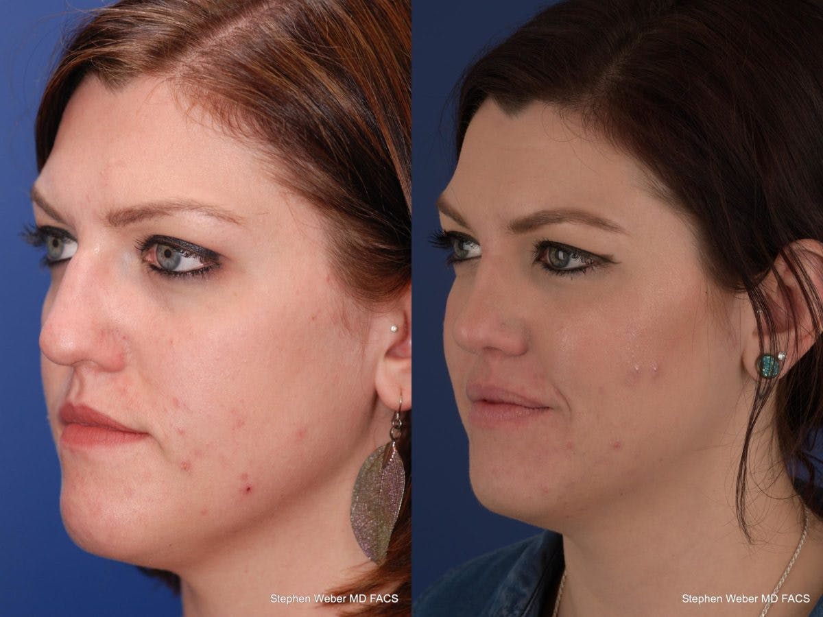 Rhinoplasty Before & After Gallery - Patient 180062 - Image 3