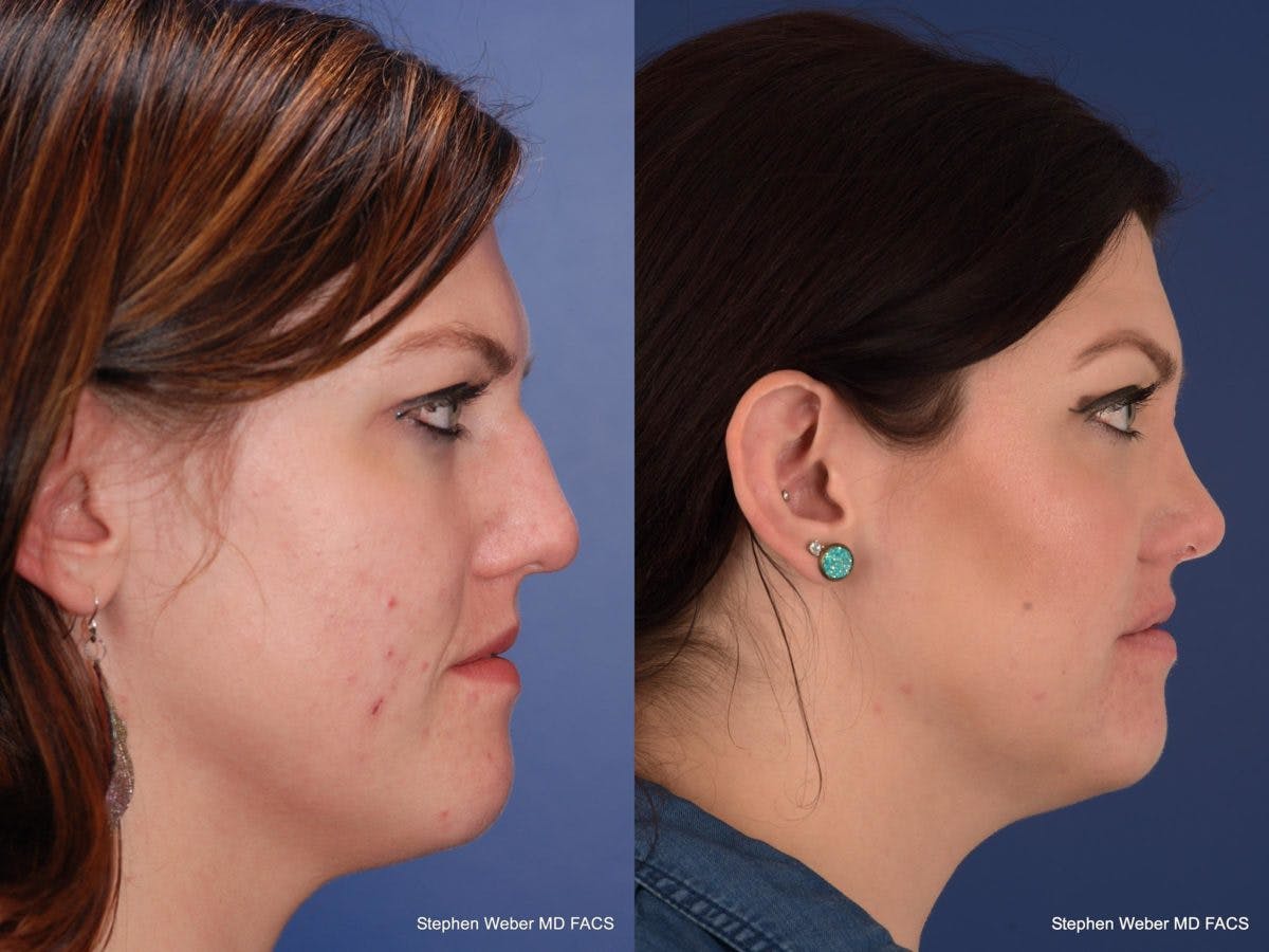 Rhinoplasty Before & After Gallery - Patient 180062 - Image 4