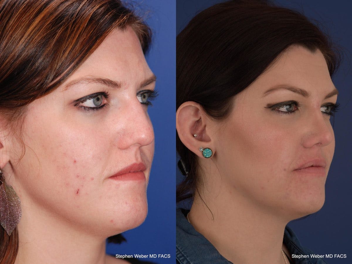 Rhinoplasty Before & After Gallery - Patient 180062 - Image 5