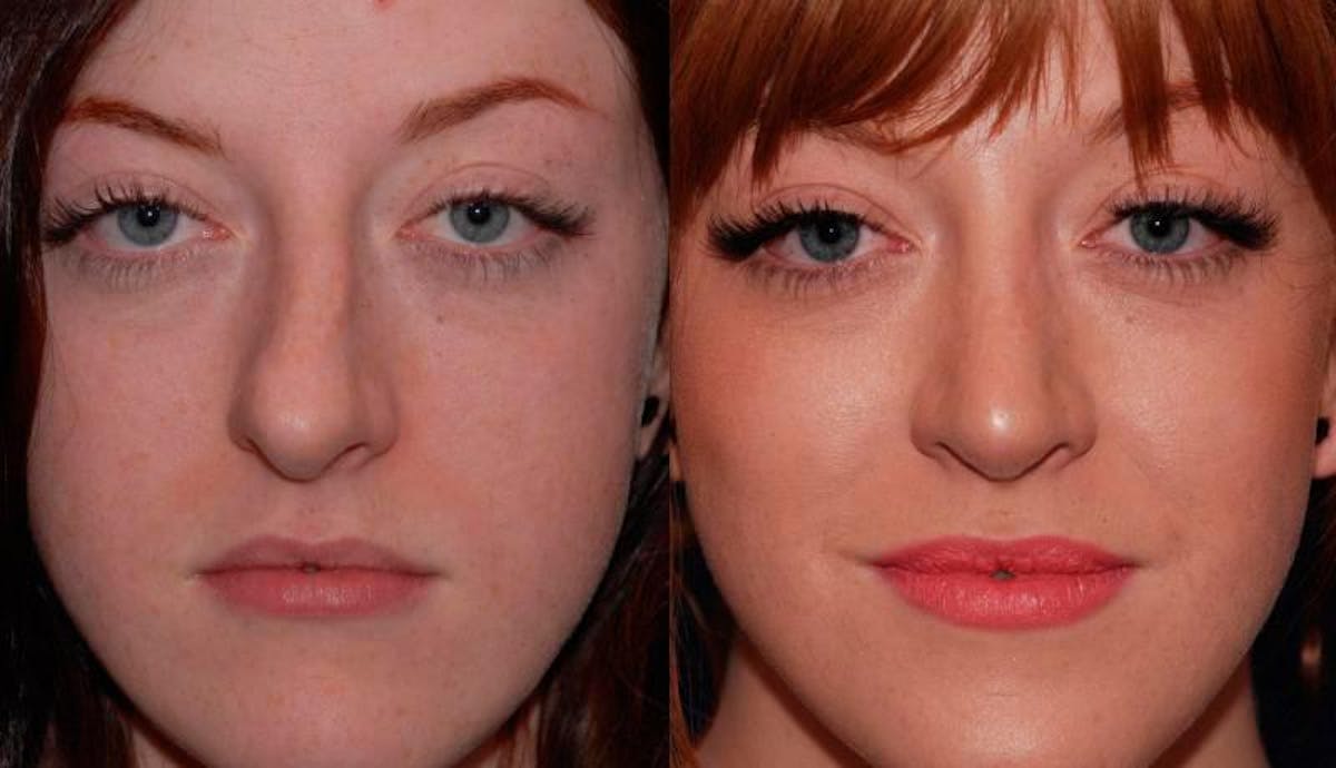 Rhinoplasty Before & After Gallery - Patient 189568 - Image 1