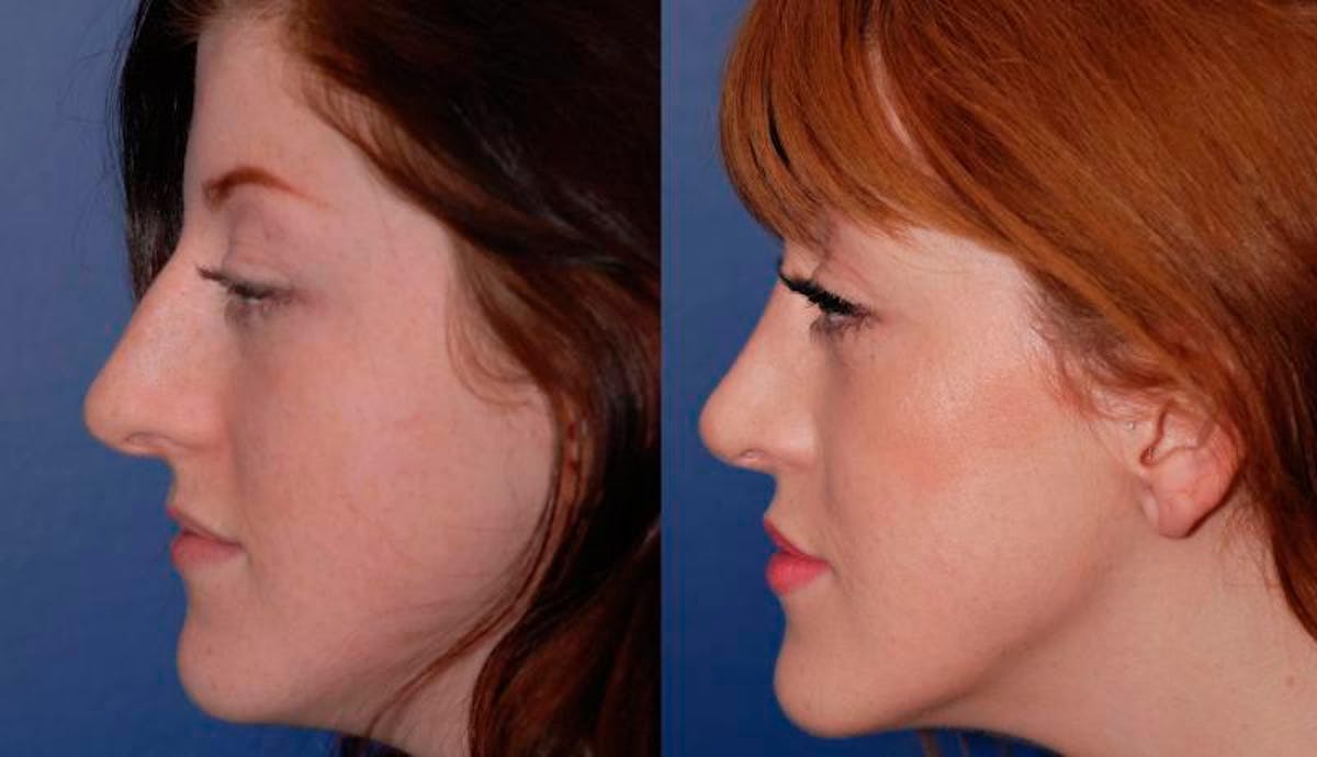 Rhinoplasty Before & After Gallery - Patient 189568 - Image 2