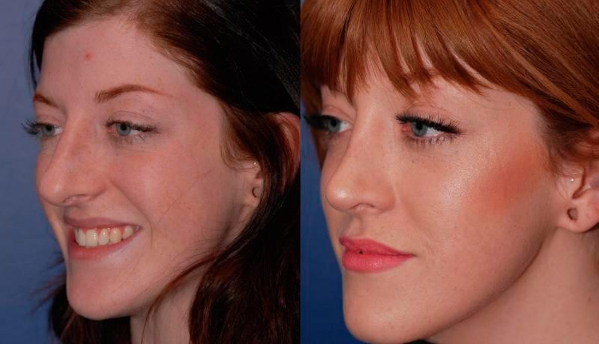Rhinoplasty Before & After Gallery - Patient 189568 - Image 3