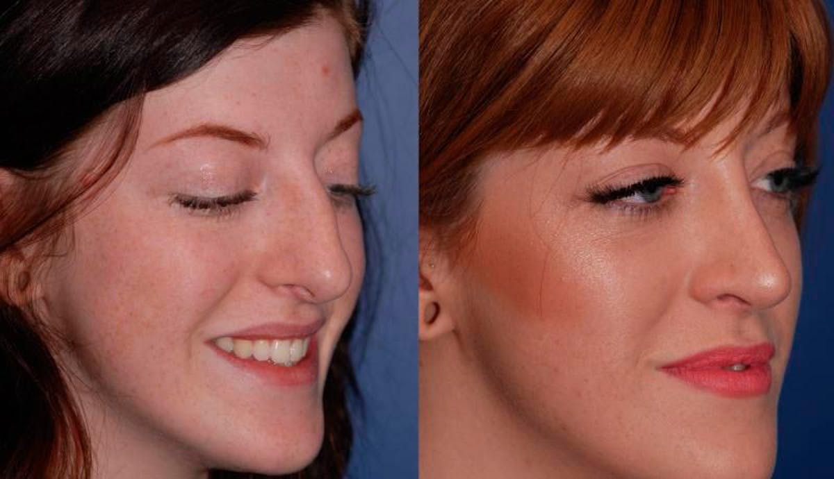 Rhinoplasty Before & After Gallery - Patient 189568 - Image 4