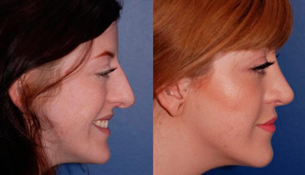 Rhinoplasty Before & After Gallery - Patient 189568 - Image 5