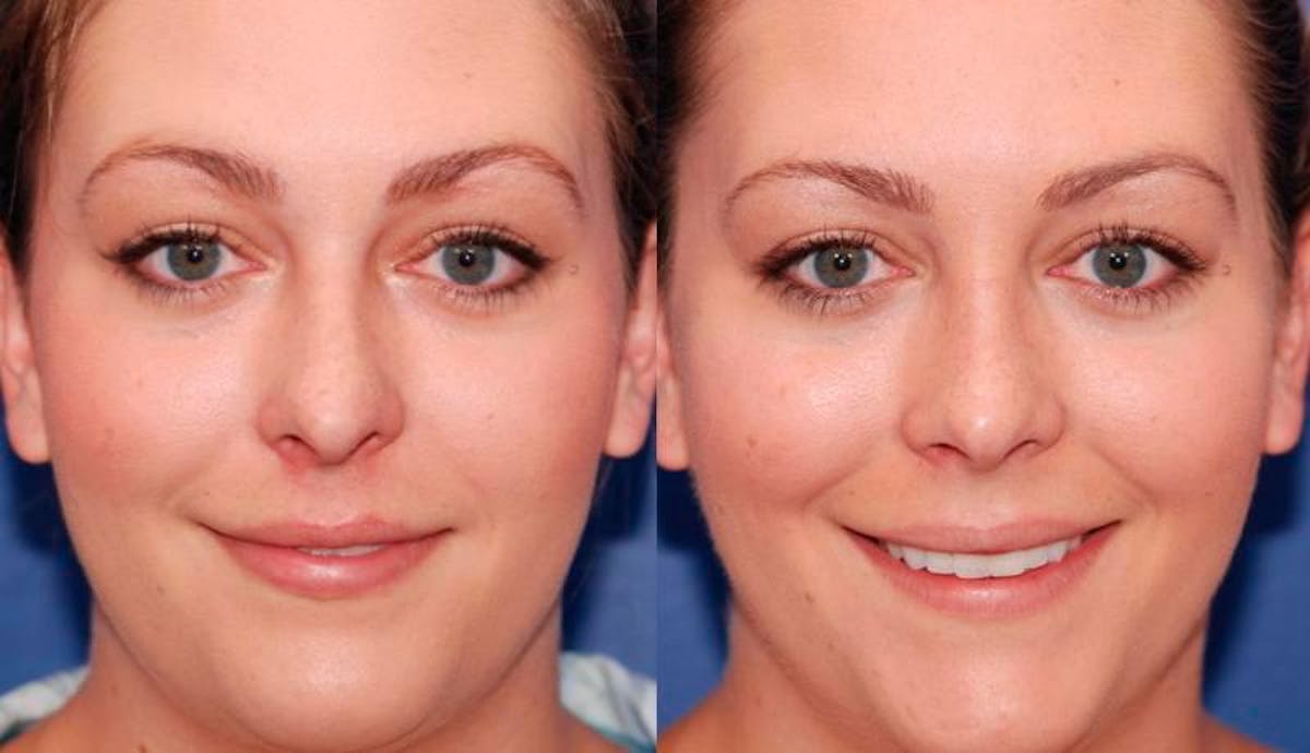 Rhinoplasty Before & After Gallery - Patient 329539 - Image 1