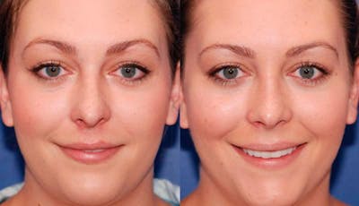 Rhinoplasty Before & After Gallery - Patient 329539 - Image 1