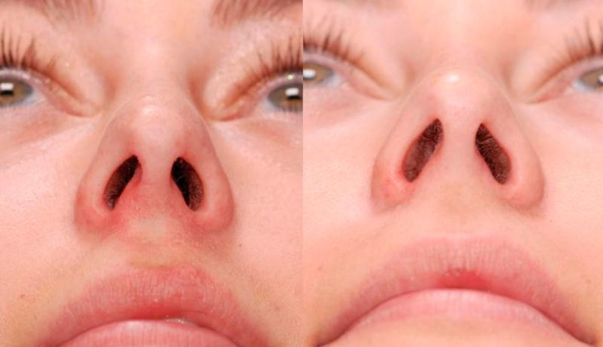 Rhinoplasty Before & After Gallery - Patient 329539 - Image 2