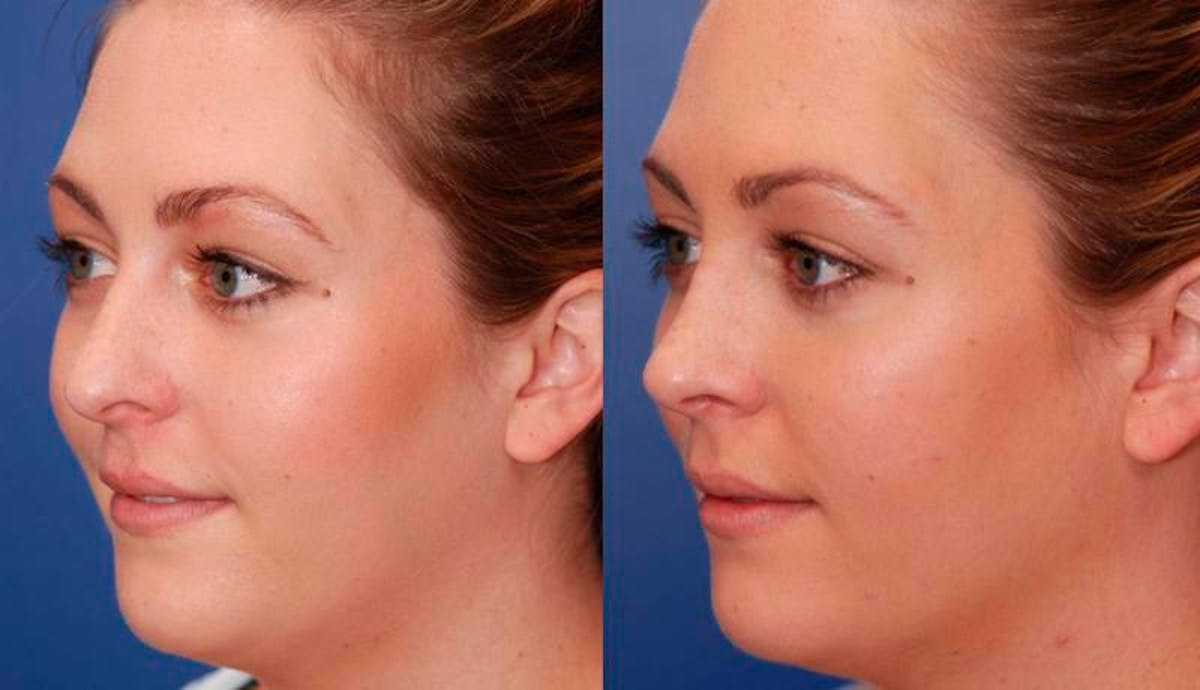 Rhinoplasty Before & After Gallery - Patient 329539 - Image 3