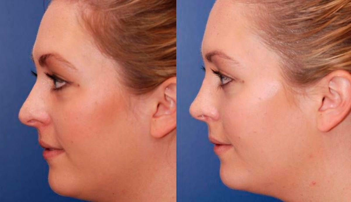 Rhinoplasty Before & After Gallery - Patient 329539 - Image 4