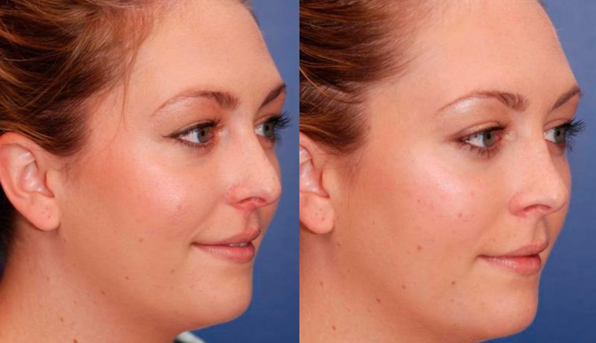 Rhinoplasty Before & After Gallery - Patient 329539 - Image 5