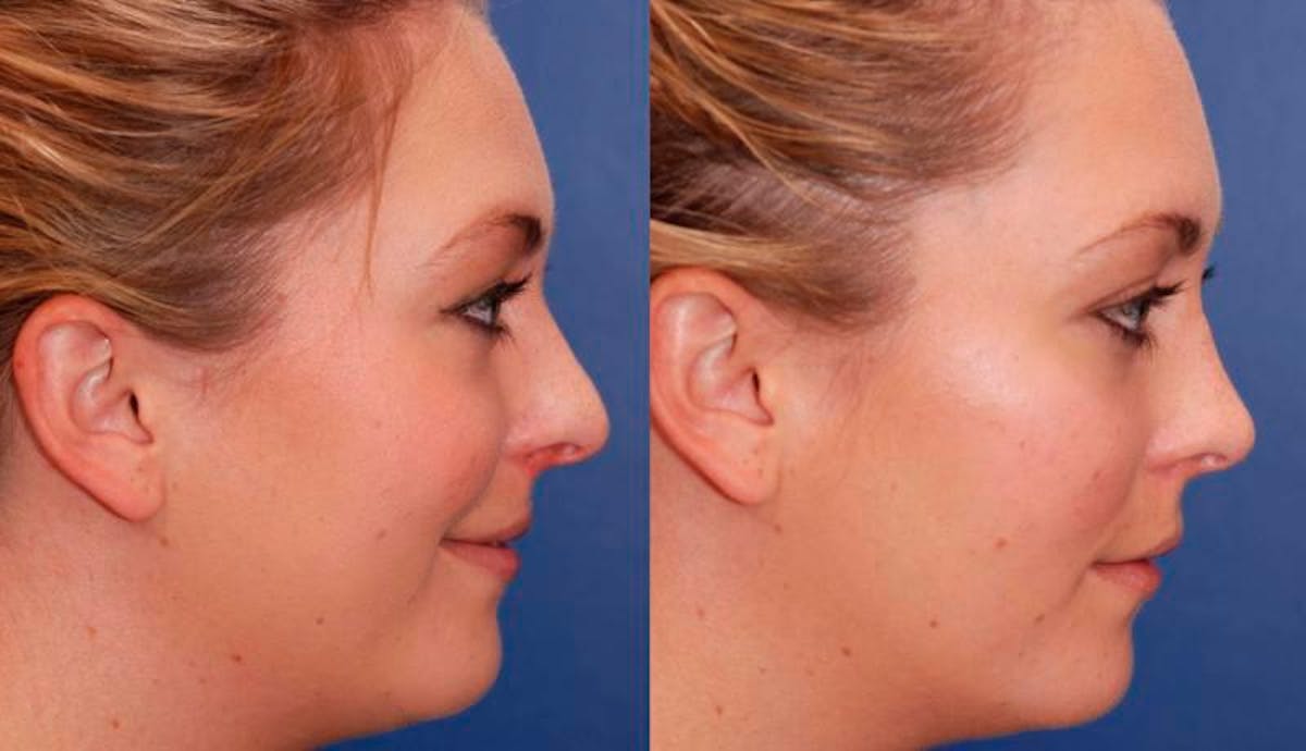 Rhinoplasty Before & After Gallery - Patient 329539 - Image 6