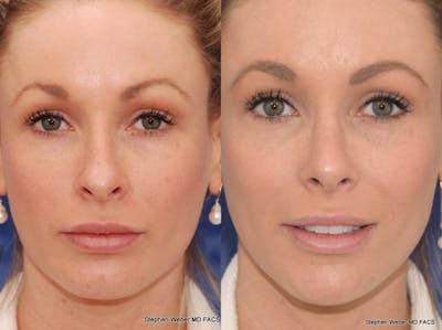 Rhinoplasty Before & After Gallery - Patient 297522 - Image 1