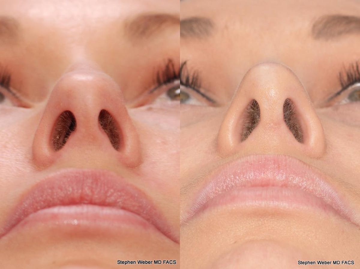 Rhinoplasty Before & After Gallery - Patient 297522 - Image 2