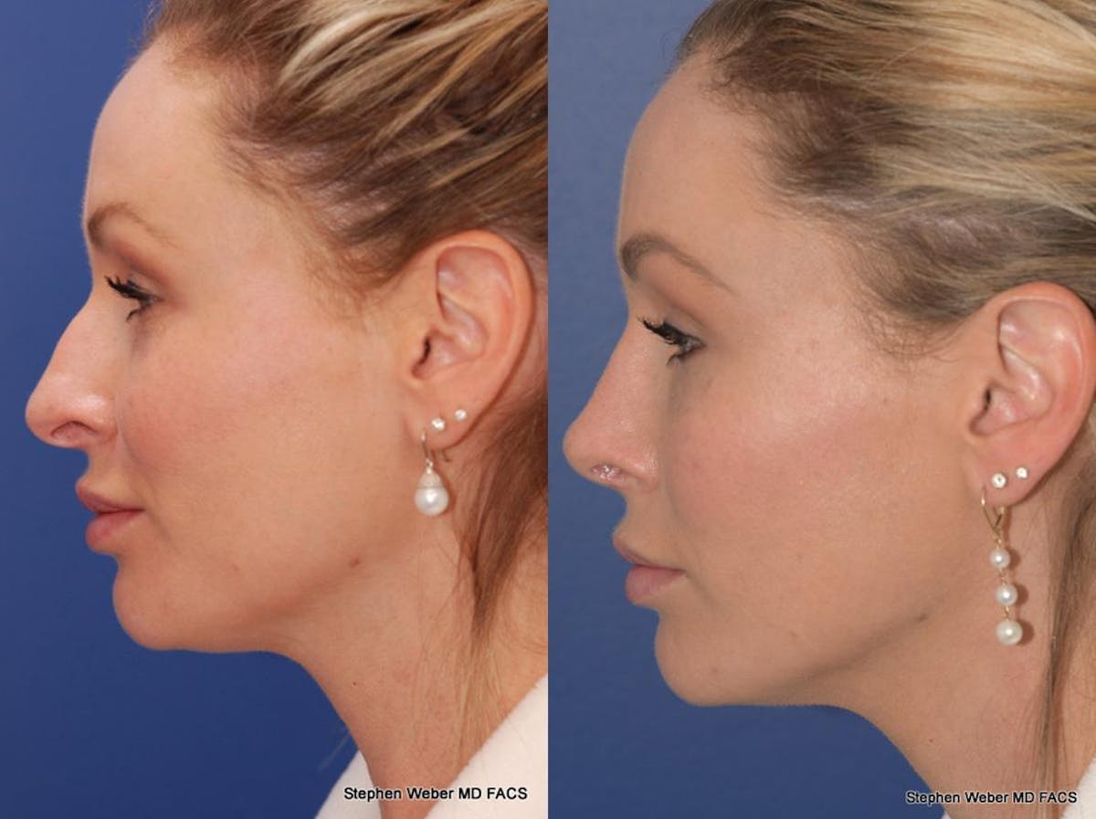 Rhinoplasty Before & After Gallery - Patient 297522 - Image 3