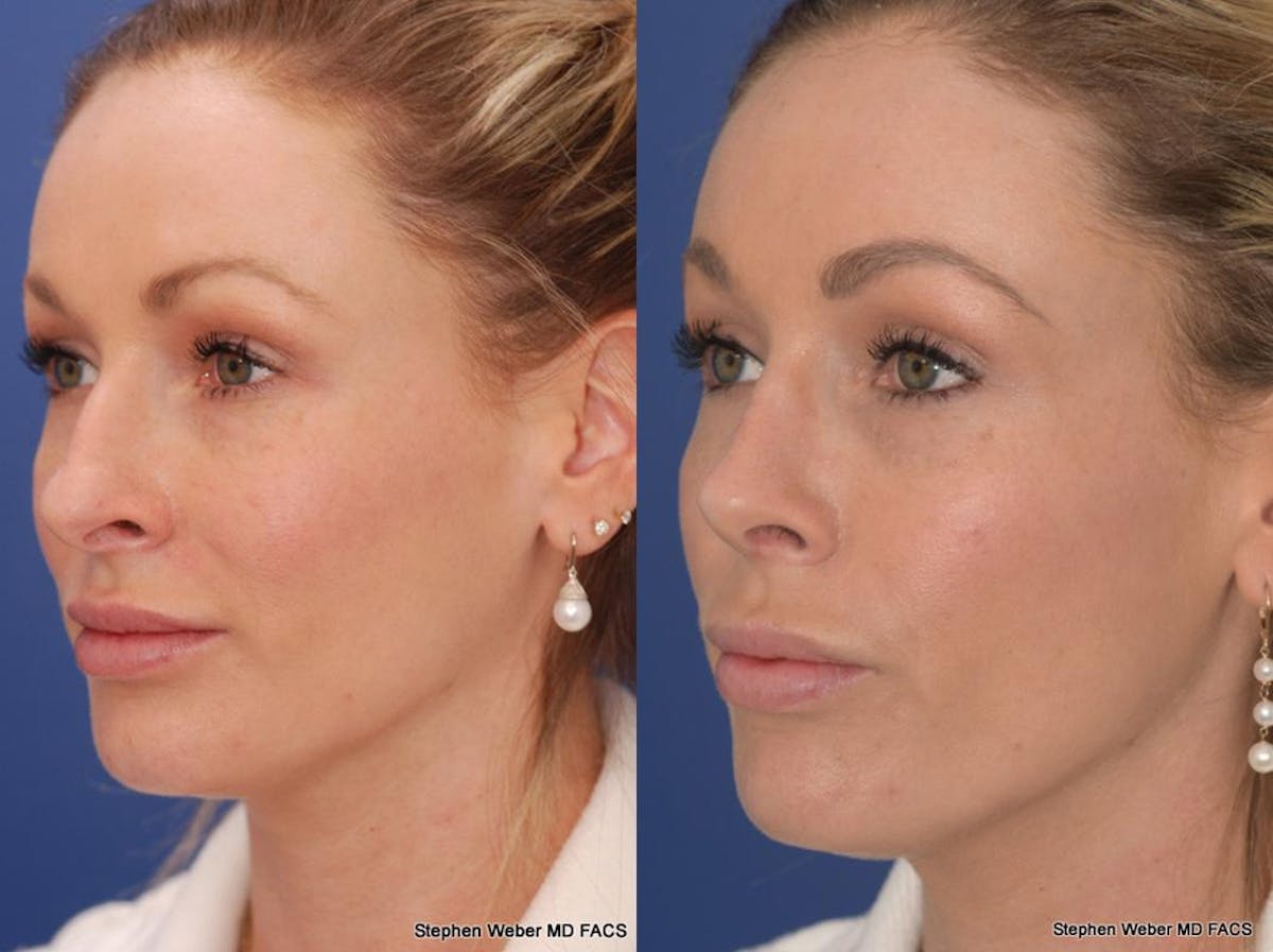 Rhinoplasty Before & After Gallery - Patient 297522 - Image 4