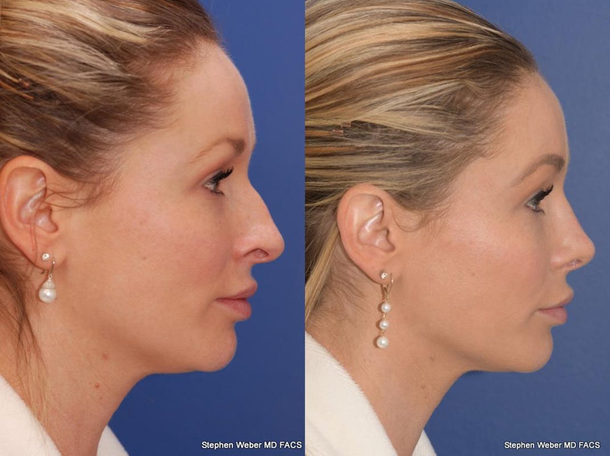 Rhinoplasty Before & After Gallery - Patient 297522 - Image 5