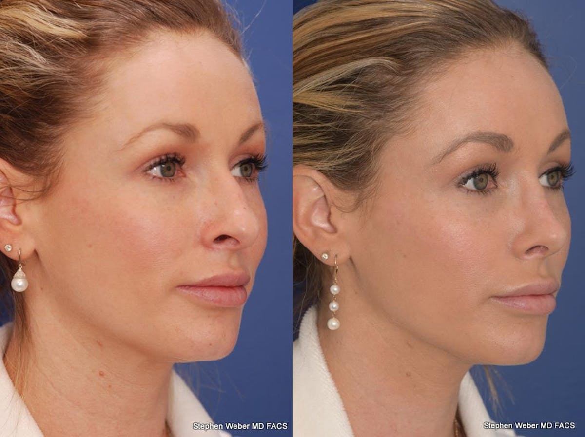 Rhinoplasty Before & After Gallery - Patient 297522 - Image 6