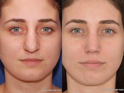 Rhinoplasty Before & After Gallery - Patient 261296 - Image 1