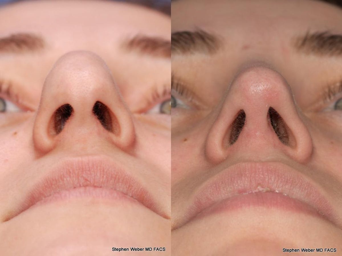 Rhinoplasty Before & After Gallery - Patient 261296 - Image 2