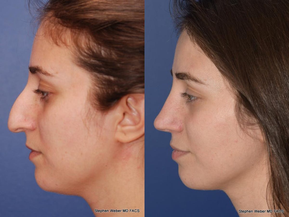 Rhinoplasty Before & After Gallery - Patient 261296 - Image 3