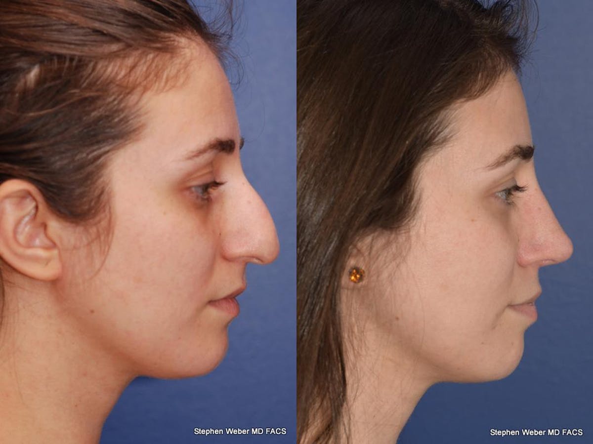 Rhinoplasty Before & After Gallery - Patient 261296 - Image 4