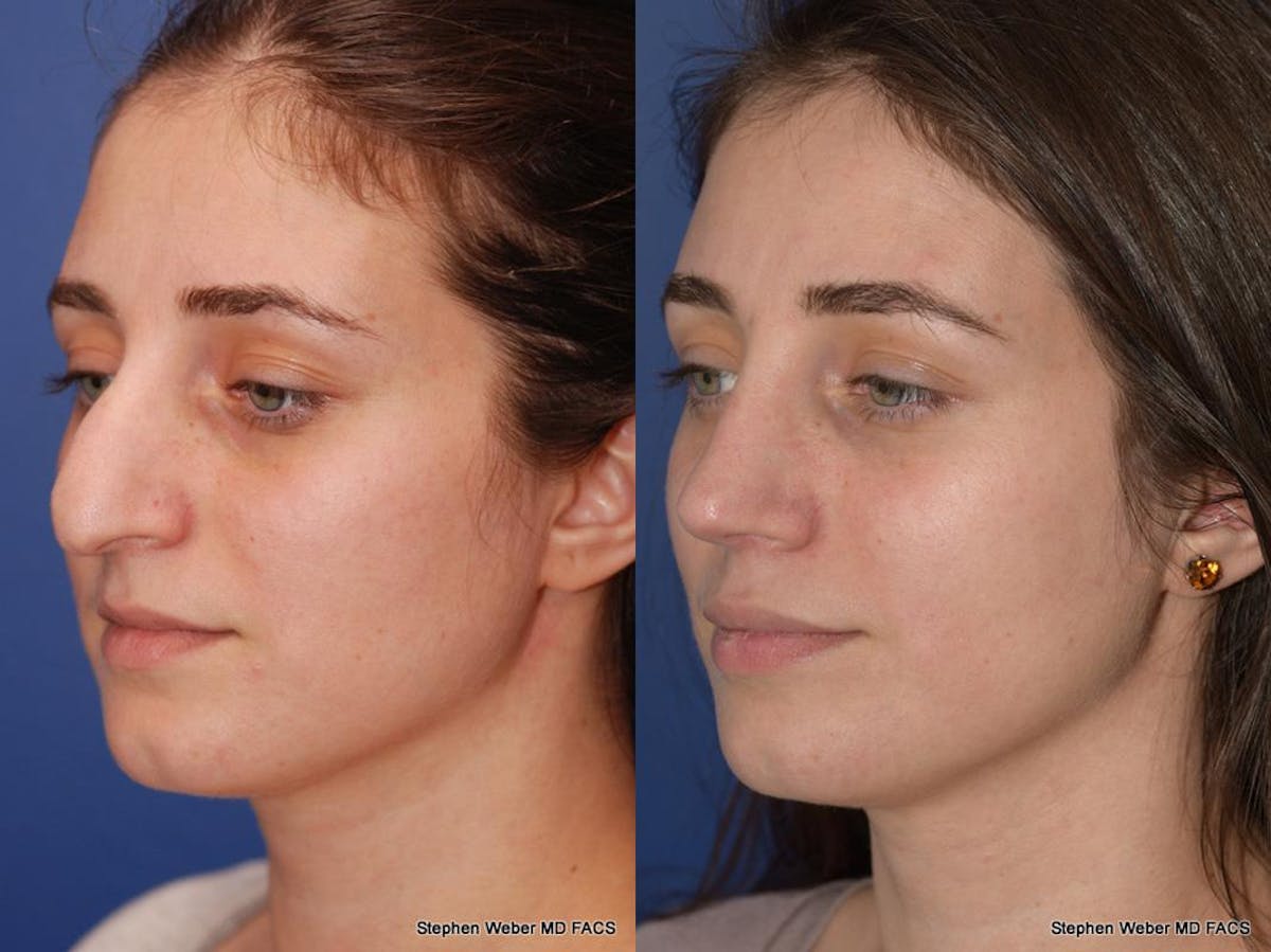 Rhinoplasty Before & After Gallery - Patient 261296 - Image 5
