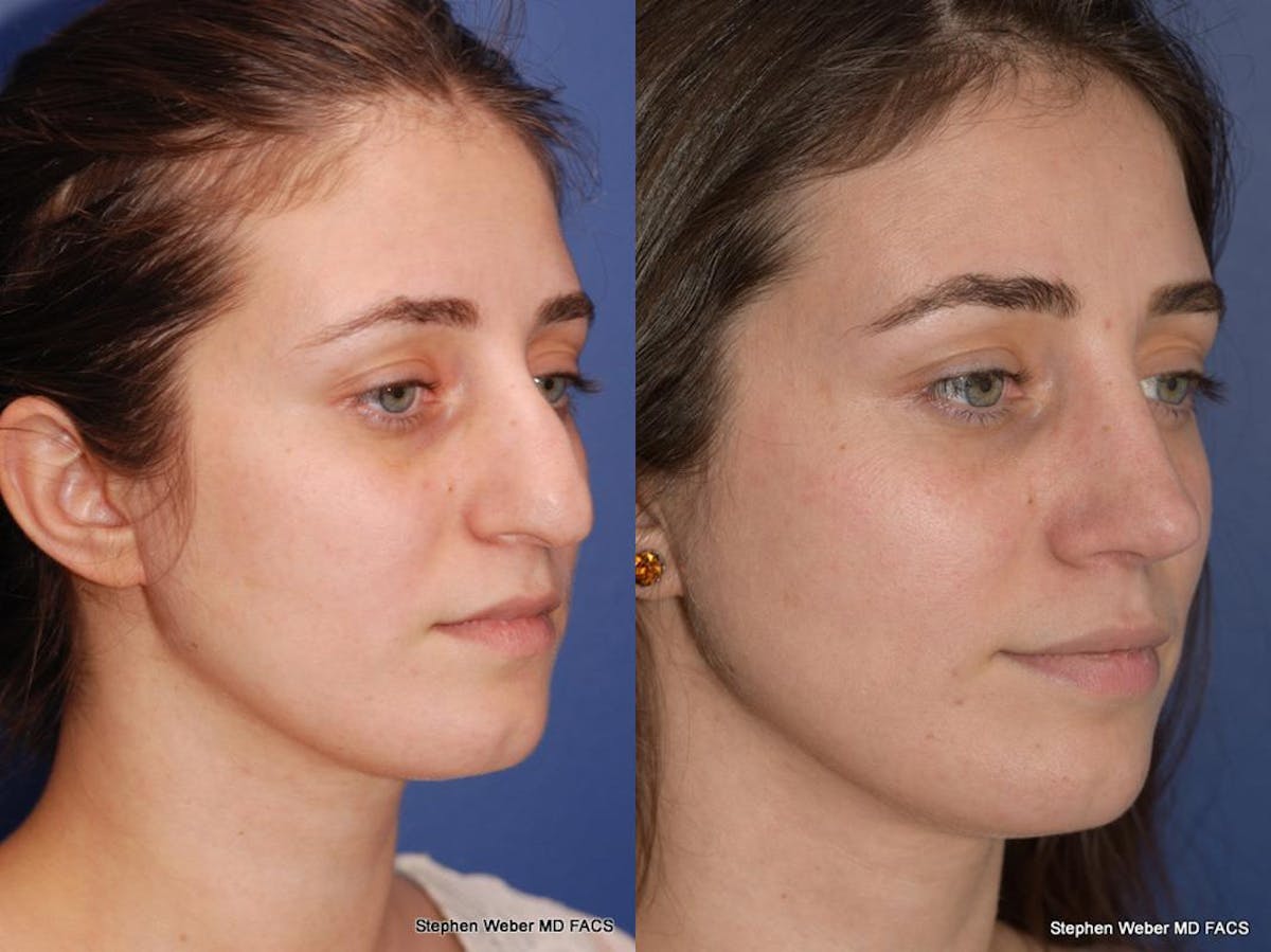 Rhinoplasty Before & After Gallery - Patient 261296 - Image 6