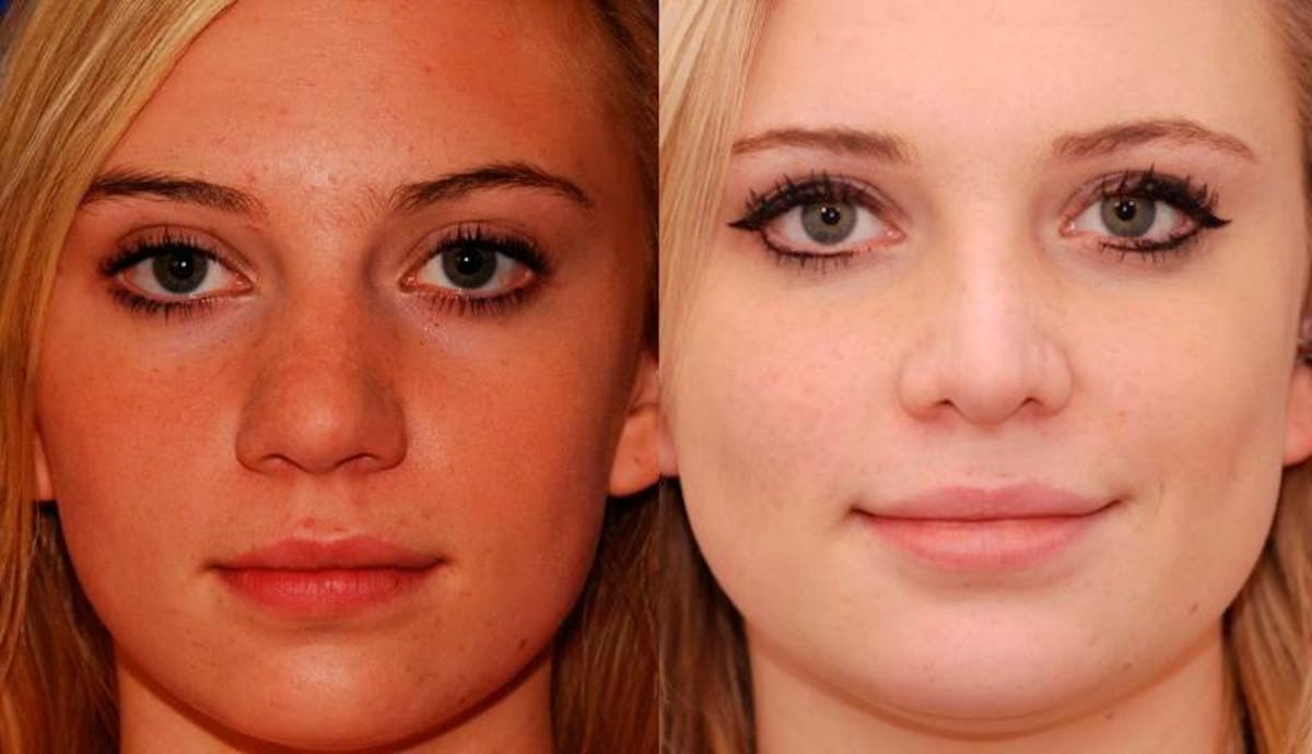 Rhinoplasty Before & After Gallery - Patient 603785 - Image 1